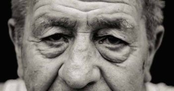 Œdèmes, poches, et festons malaires Visage avec poches sous les yeux