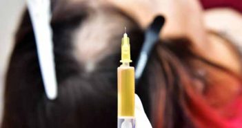 La mésothérapie pour lutter contre la perte de cheveux seringue de mésothérapie et crane dégarni