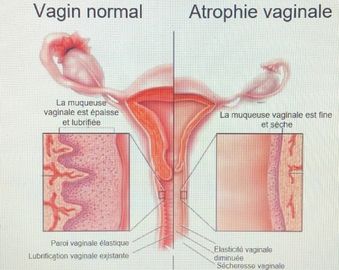 Réhydratation vaginale à l'acide hyaluronique | AFME