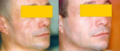 visage creux : resultat d'injections avant apres