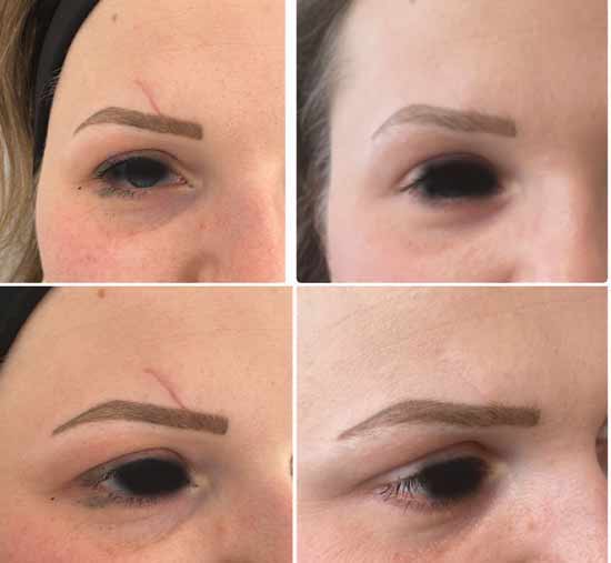 laser pour effacer cicatrice