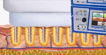 La Radiofréquence 4 Mhz – utilisation en dermatologie et avantages patients radiofrequence 4 Mhz
