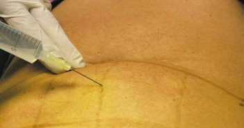Anesthésie locale : la technique tumescente revisitée Injection anesthésique tumecente
