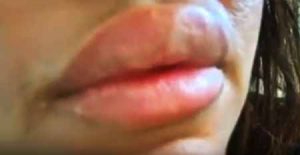 lèvres trop gonflées