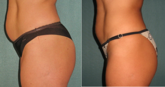 Avant et après radiofréquence cellulite