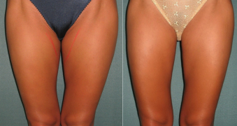 Résultats radiofréquence cellulite cuisses