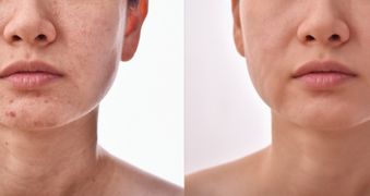 Peeling du visage superficiel (doux) : une peau renouvellée
