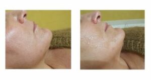 Microneedling pores dilatés