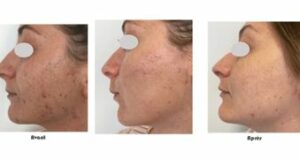 Enlever cicatrices acnés microneedling