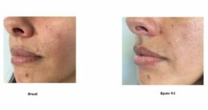 Enlever cicatrice traumatique microneedling