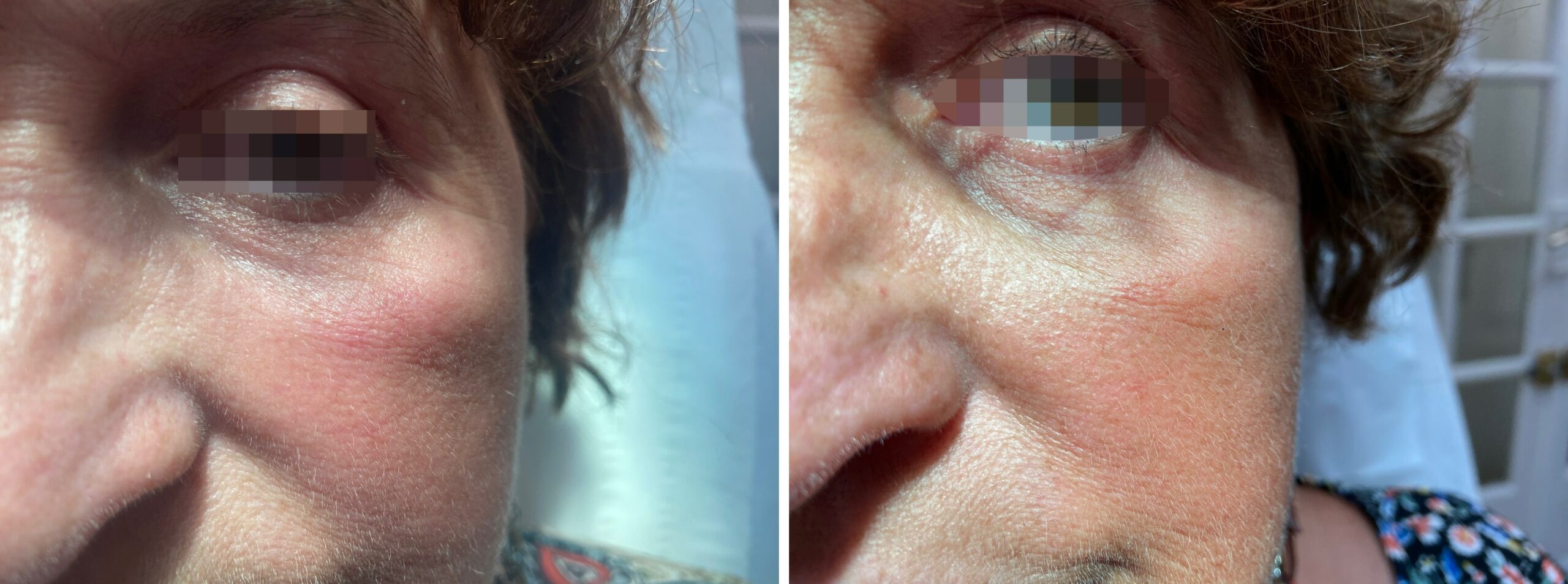 Poches Malaires Oedeme Lymphatique Sous L Oeil