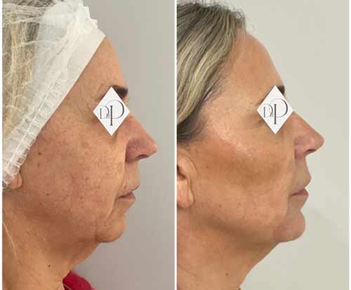 fils tenseurs et injections du visage avant apres