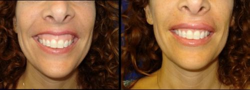 Traitement du sourire botox avant et après