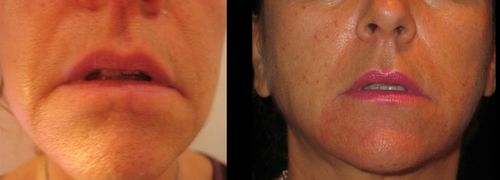 Botox pour des lèvres mieux définies avant et après
