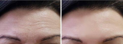 Botox front avant et après