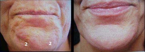 Botox menton avant et après