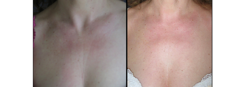 Avant et après botox décolleté
