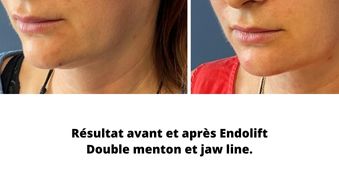 Résultat avant et après Endolift Double menton et jaw line.