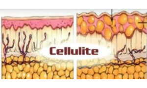 Formation cellulite