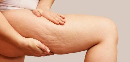 Cellulite et peau d'orange sur la cuisse