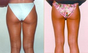 Avant après cellulite culotte de cheval et cuisses