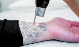  Le détatouage laser pour enlever un tatouage