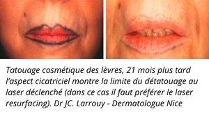 Détatouage lèvres avant et après