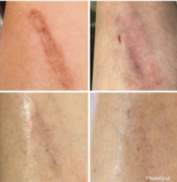 Cicatrice avant, pendant et après traitement laser