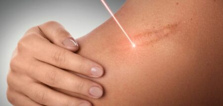 Traitement des cicatrices par laser