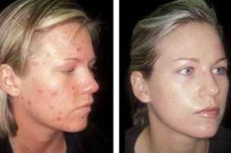 avant et après le traitement des cicatrices d’acné