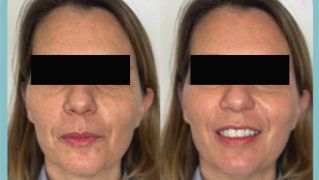 Avant et après injections visage