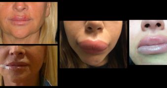Effets secondaires injections lèvres