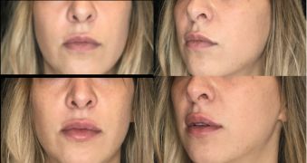 Avant et après injections lèvres