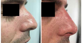Correction nez avec injections
