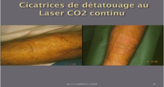 Cicatrices détatouage laser