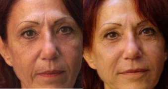 Avant après injections PRP