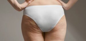 cellulite sur des cuises de femme