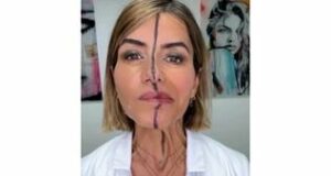 Effet botox visage
