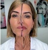 Effet botox visage