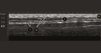 Image échographique obtenue avec un transducteur MFU-V