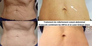 Traitement combiné du relâchement cutané abdominal léger