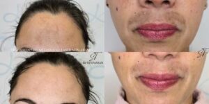 Traitement du mélasma par laser Erbium Glass fractionné