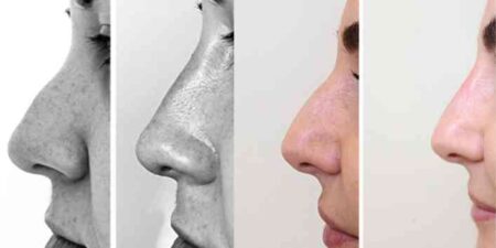 Revue de littérature scientifique : l‘angle naso-frontal ANF