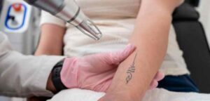 Enlever tatouage laser