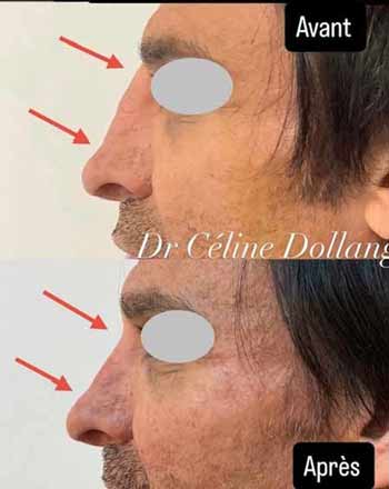 rhinoplastie medicale