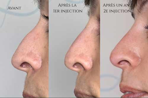 injections correctrices du nez