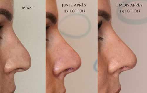 remodelage du nez rhinoplastie medicale (avant apres injections)