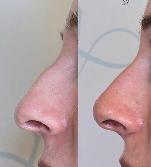 rhino-modulation par injections avant-apres