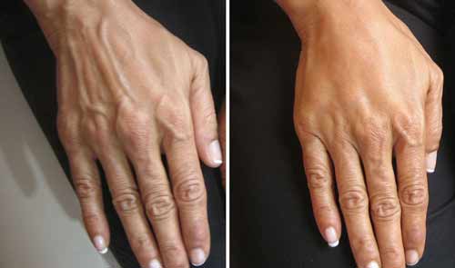 rajeunissement des mains par injections avant-apres