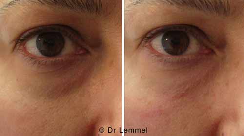 remplissage des cernes avant apres